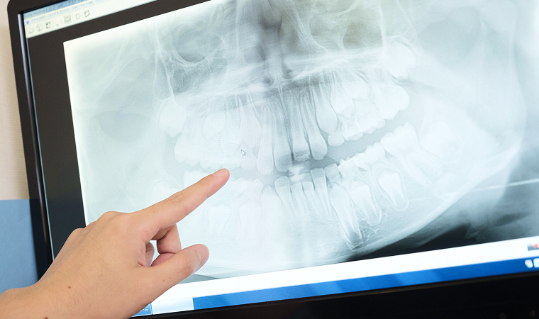 歯のレントゲンをチェックする医師